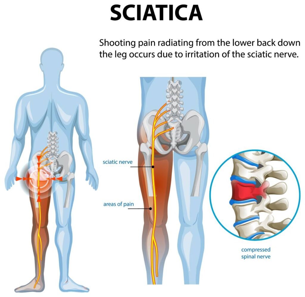 what is Sciatica